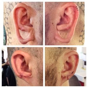 Lobe Repair Before and After